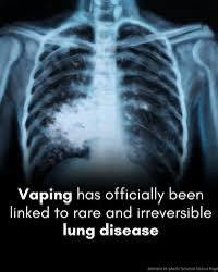 Vaping Has Officially Been Linked To Rare Irreversible Lung Disease